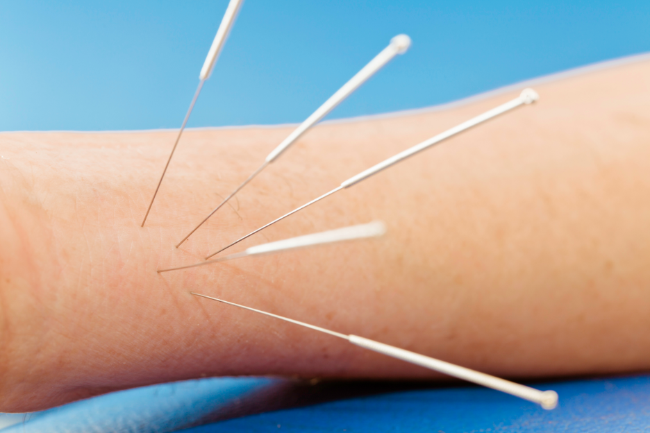 Acupuncture for Improved Eyesight in St. Petersburg, FL