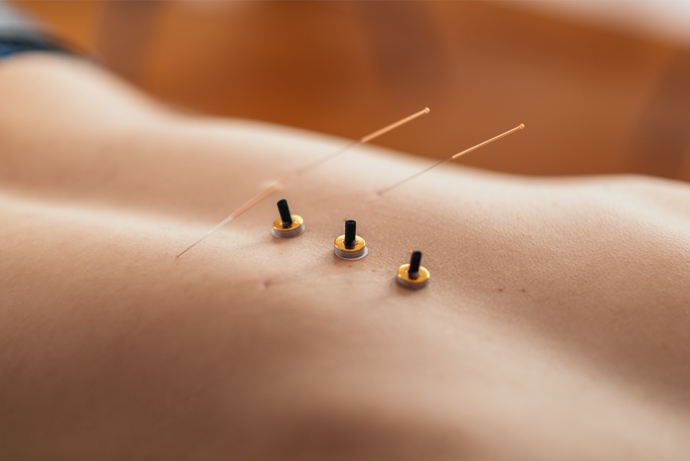 Acupuncture for Increased Energy in St. Petersburg, FL