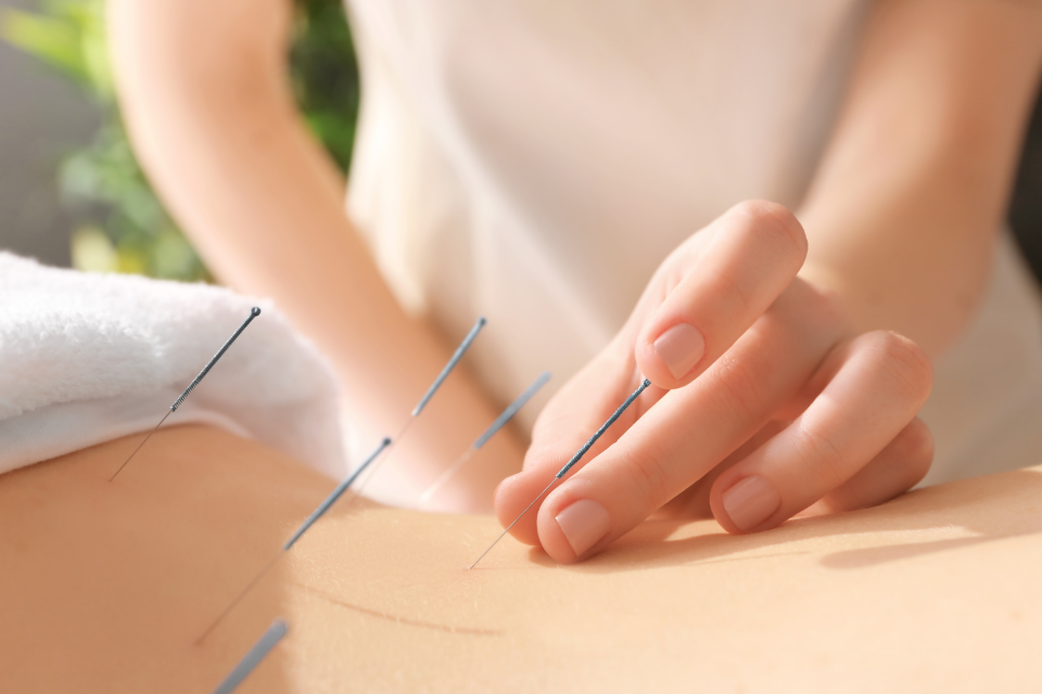 Acupuncture for Pain in St. Petersburg, FL