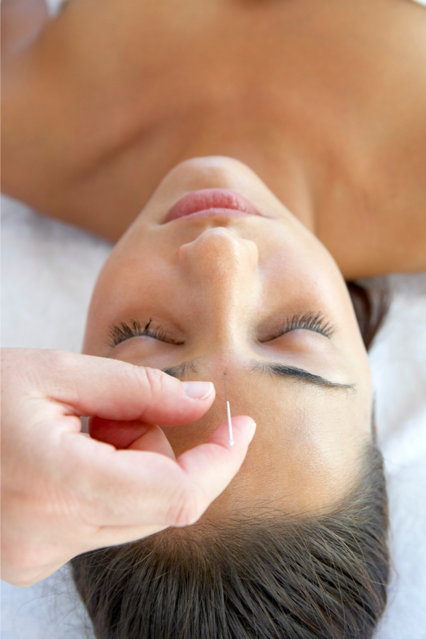 Acupuncture for Stress Reduction in St. Petersburg, FL