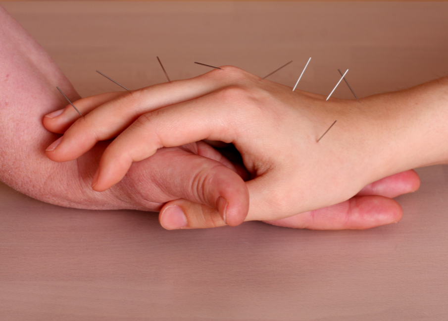Athletic Performance Acupuncture in St. Petersburg, FL