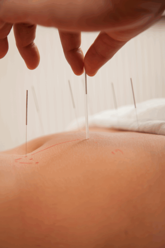 Fertility Acupuncture Therapy in St. Petersburg, FL
