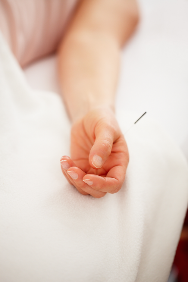 Headache or Migraine Acupuncture in St. Petersburg, FL