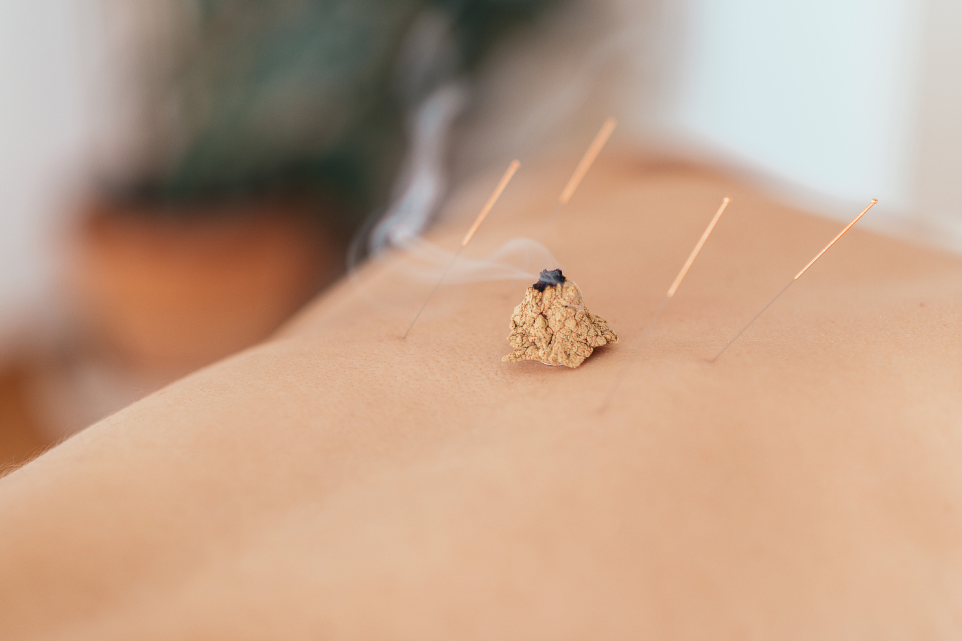 Moxibustion Acupuncture in St. Petersburg, FL