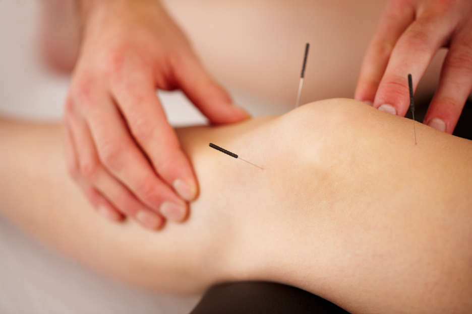 Acupuncture for Arthritis- Osteoarthritis, Rheumatoid Arthritis, Joint Pain