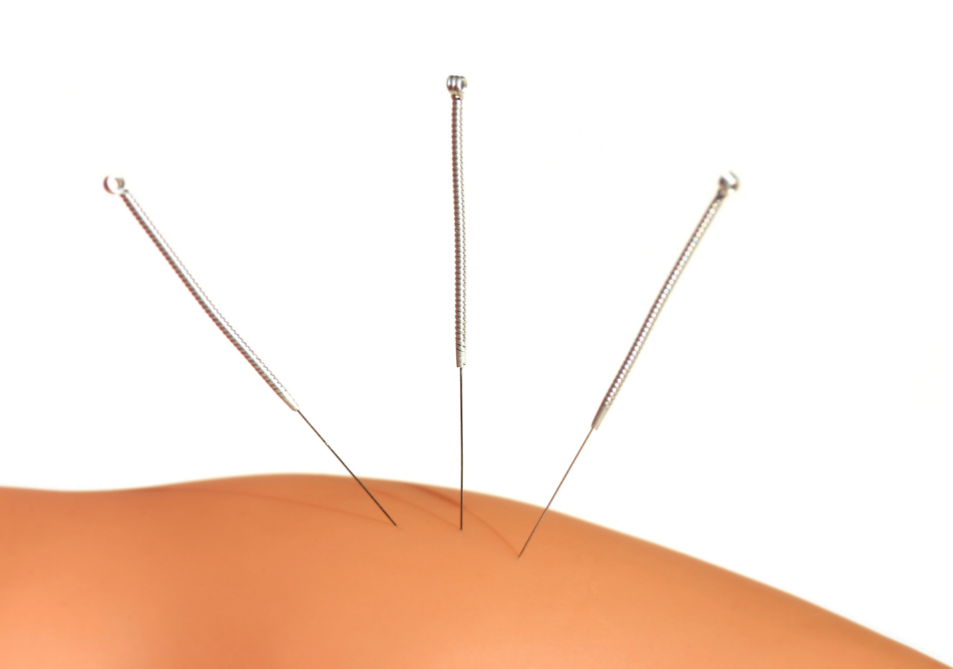 Acupuncture for Pain in the Tennis or Golfer’s Elbow