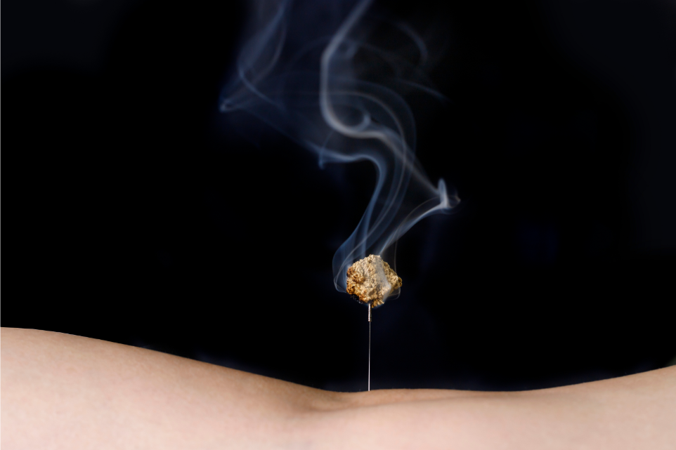 Moxibustion Acupuncture for Turning Breech Babies