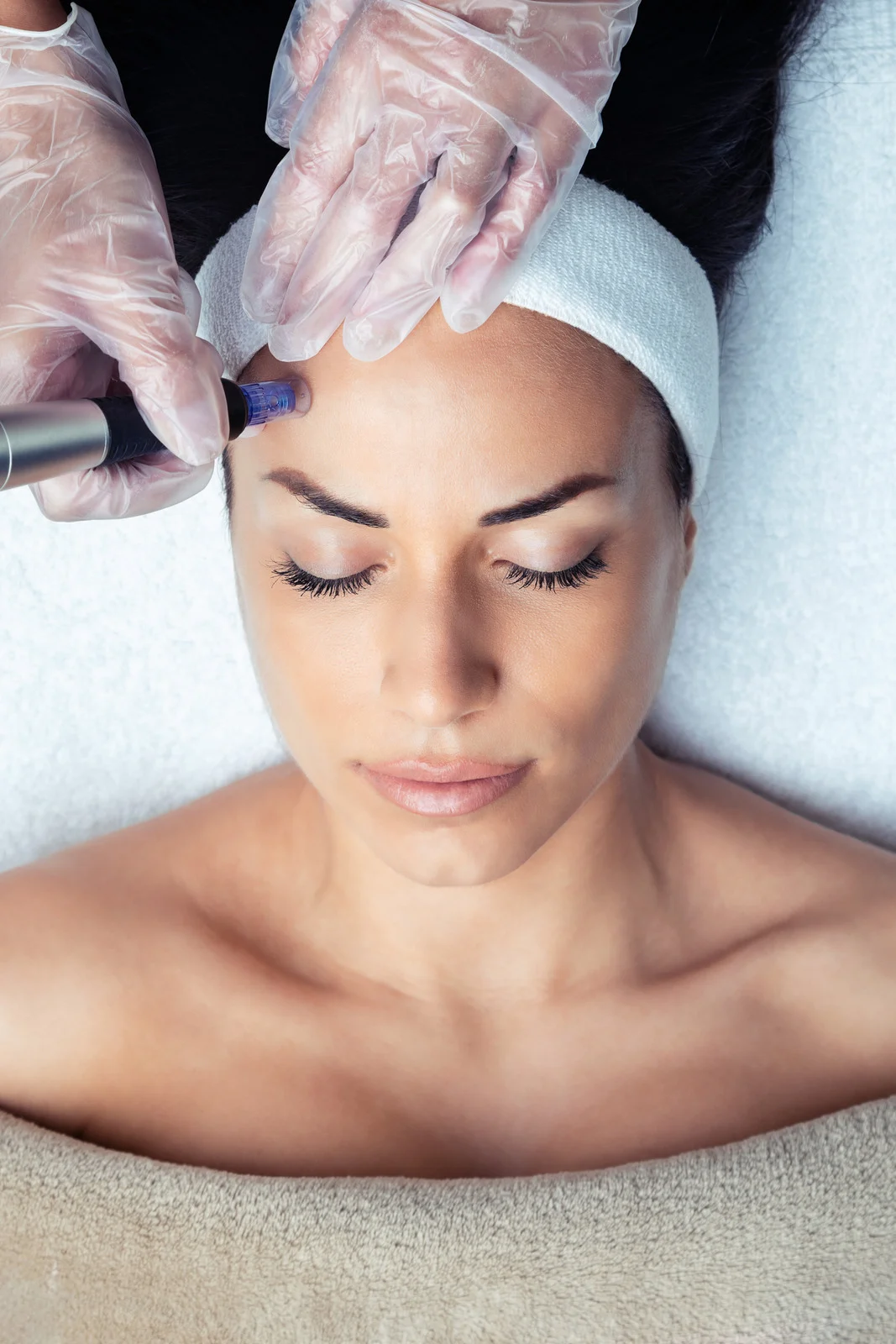 Art of Acupuncture's Microneedling
