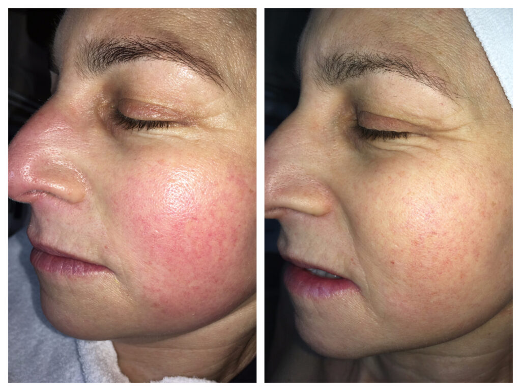 Microneedling Treatment in St. Petersburg, FL for Rosacea