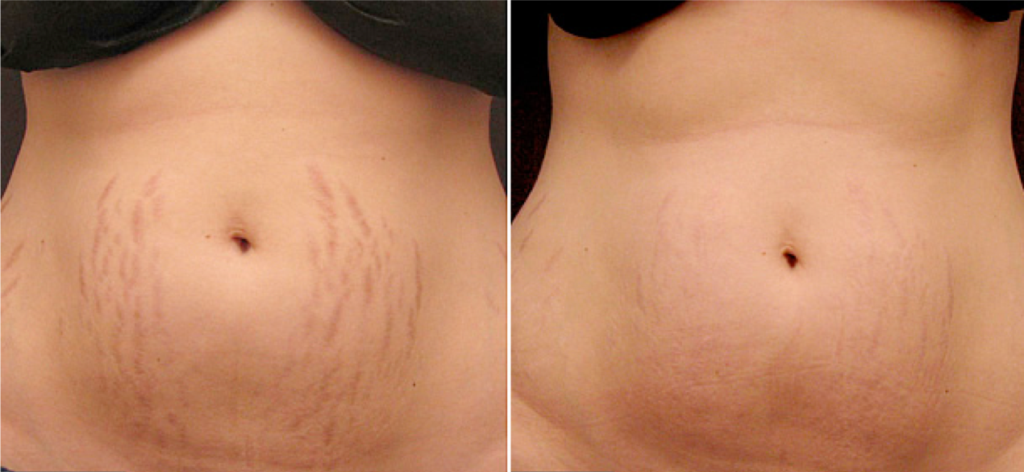 Microneedling in St. Petersburg, FL for Stretch Marks