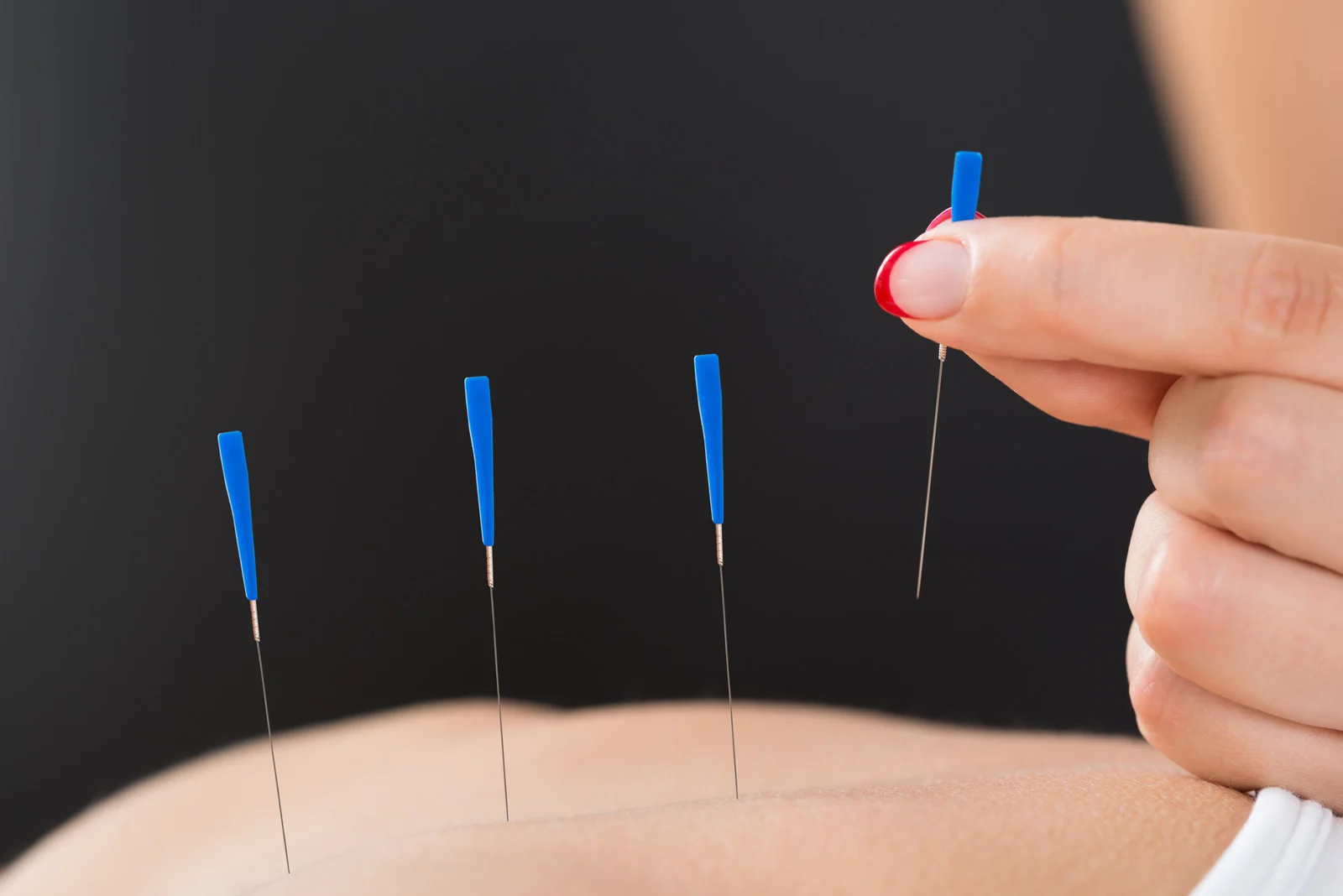 Pediatric Acupuncture